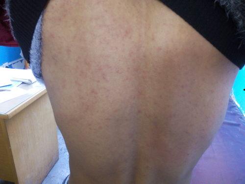 吃瓜起疹子,揭秘瓜果过敏背后的健康谜团