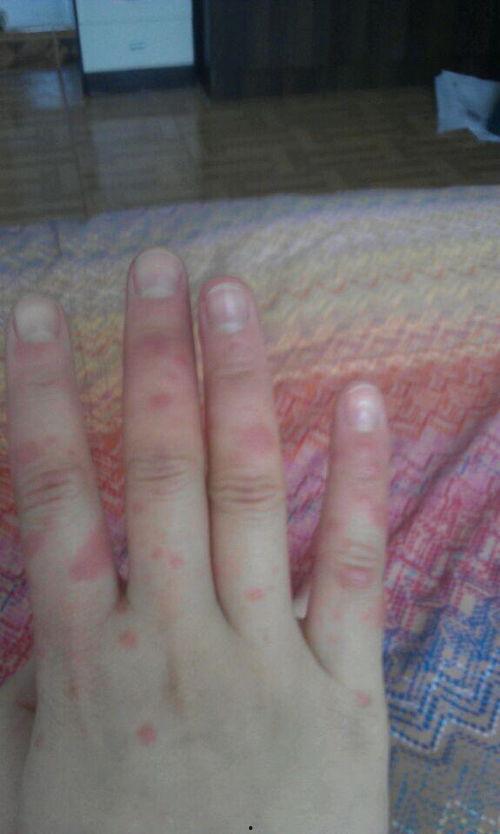 吃瓜起疹子,揭秘瓜果过敏背后的健康谜团